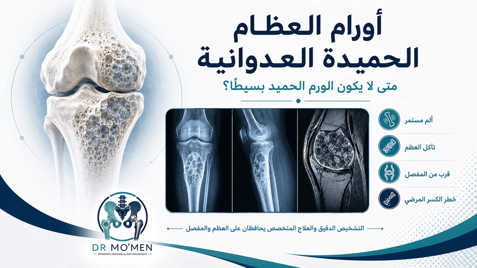 أورام العظام الحميدة العدوانية ومتى يحتاج الورم الحميد في العظام إلى علاج متخصص