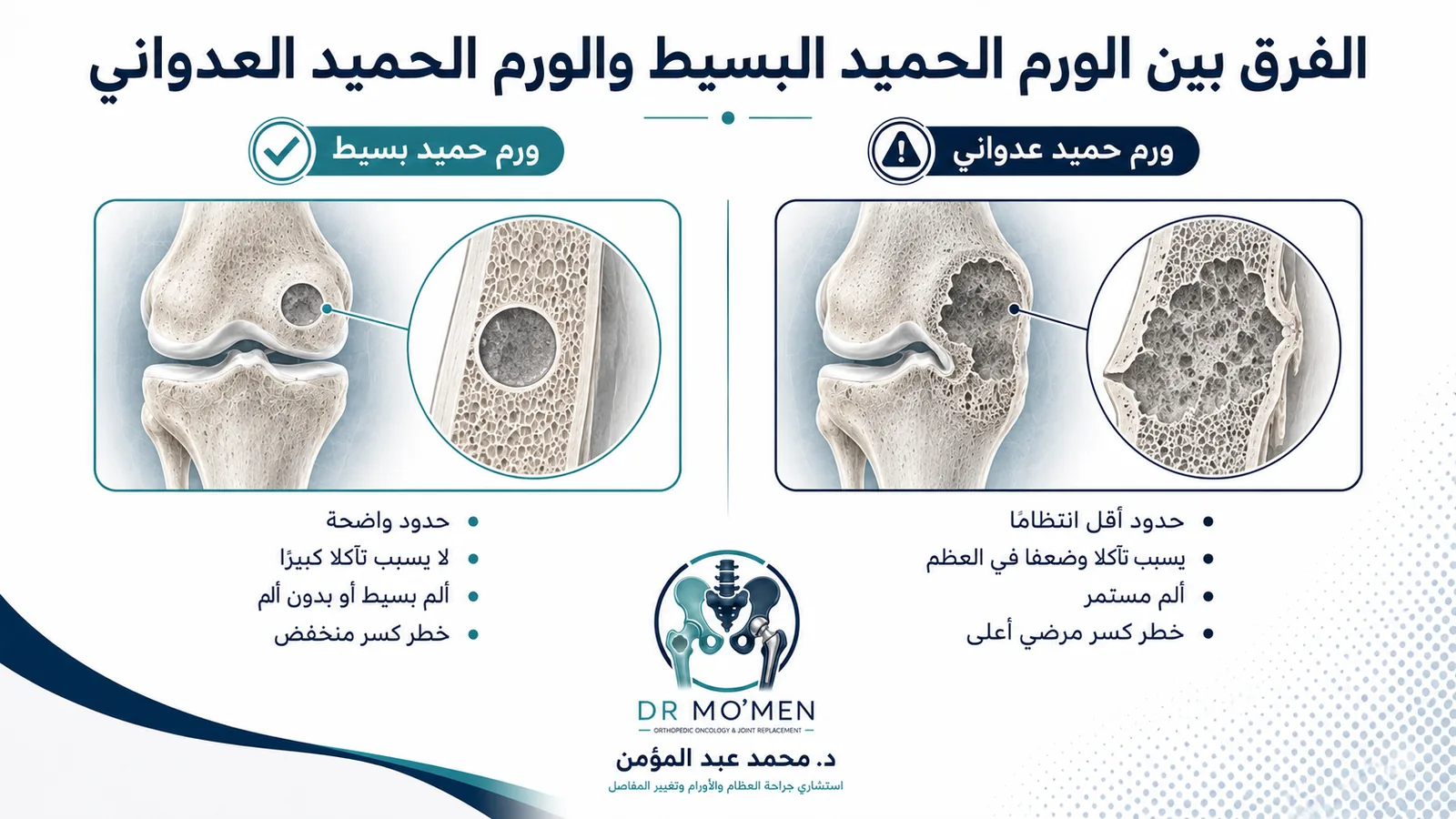 الفرق بين الورم العظمي الحميد البسيط والورم الحميد العدواني الذي يضعف العظمة