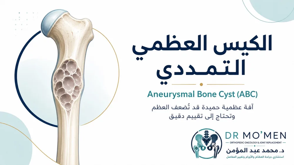 الكيس العظمي التمددي ABC: متى يكون أكثر نشاطًا؟ — صورة توضيحية داخل المقال رقم 1