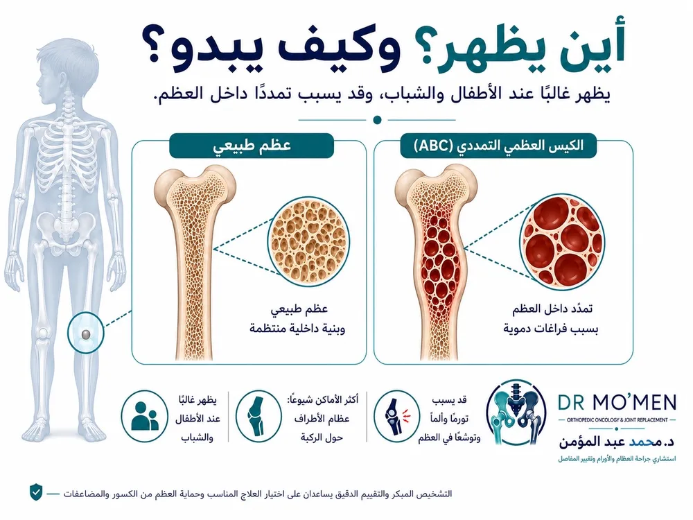 الكيس العظمي التمددي ABC: متى يكون أكثر نشاطًا؟ — صورة توضيحية داخل المقال رقم 2