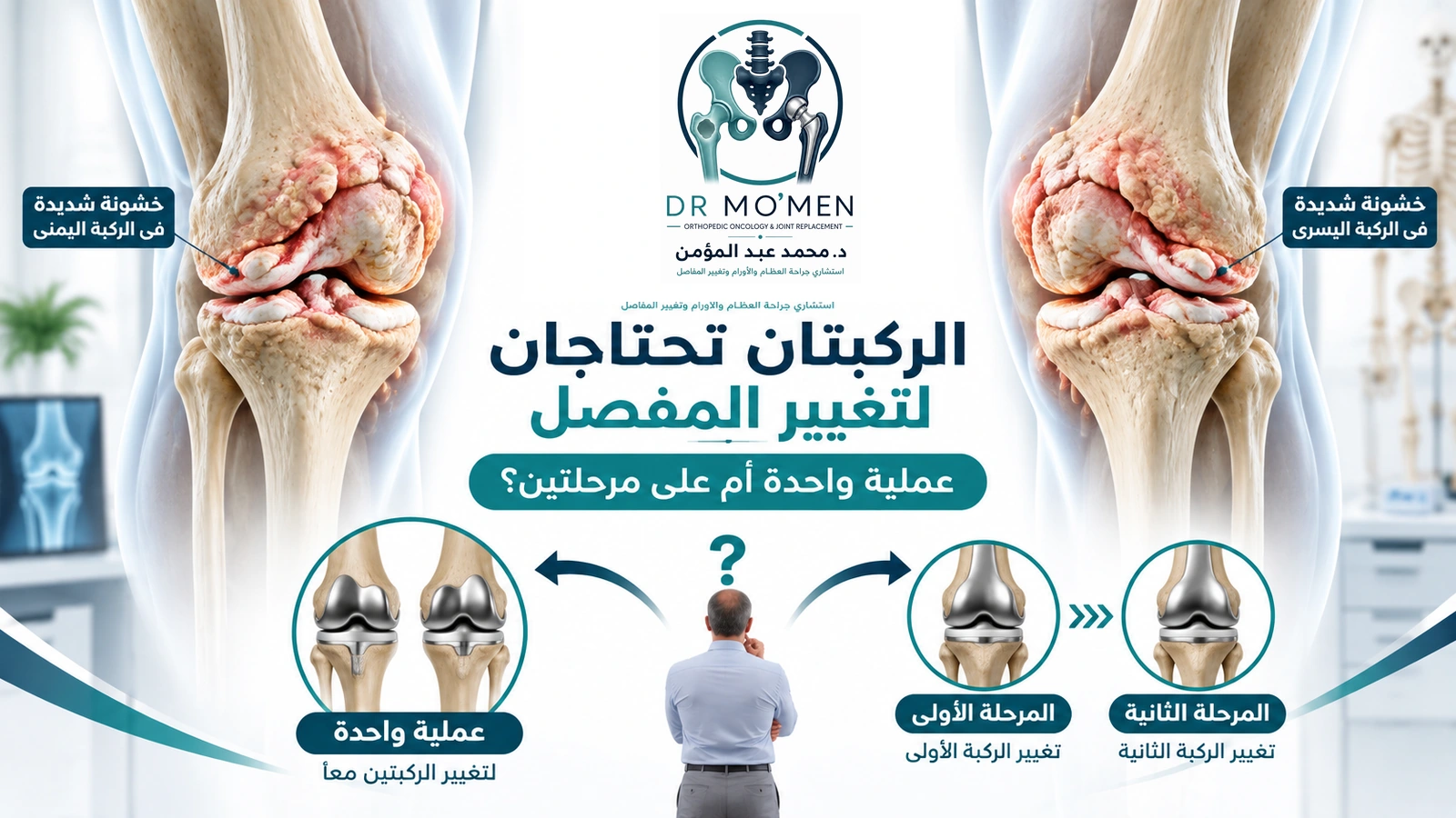 الركبتان تحتاجان لتغيير المفصل: عملية واحدة أم على مرحلتين؟ رسم طبي يوضح خشونة شديدة في الركبتين ومقارنة تغيير مفصلي الركبتين في عملية واحدة أو على مرحلتين.