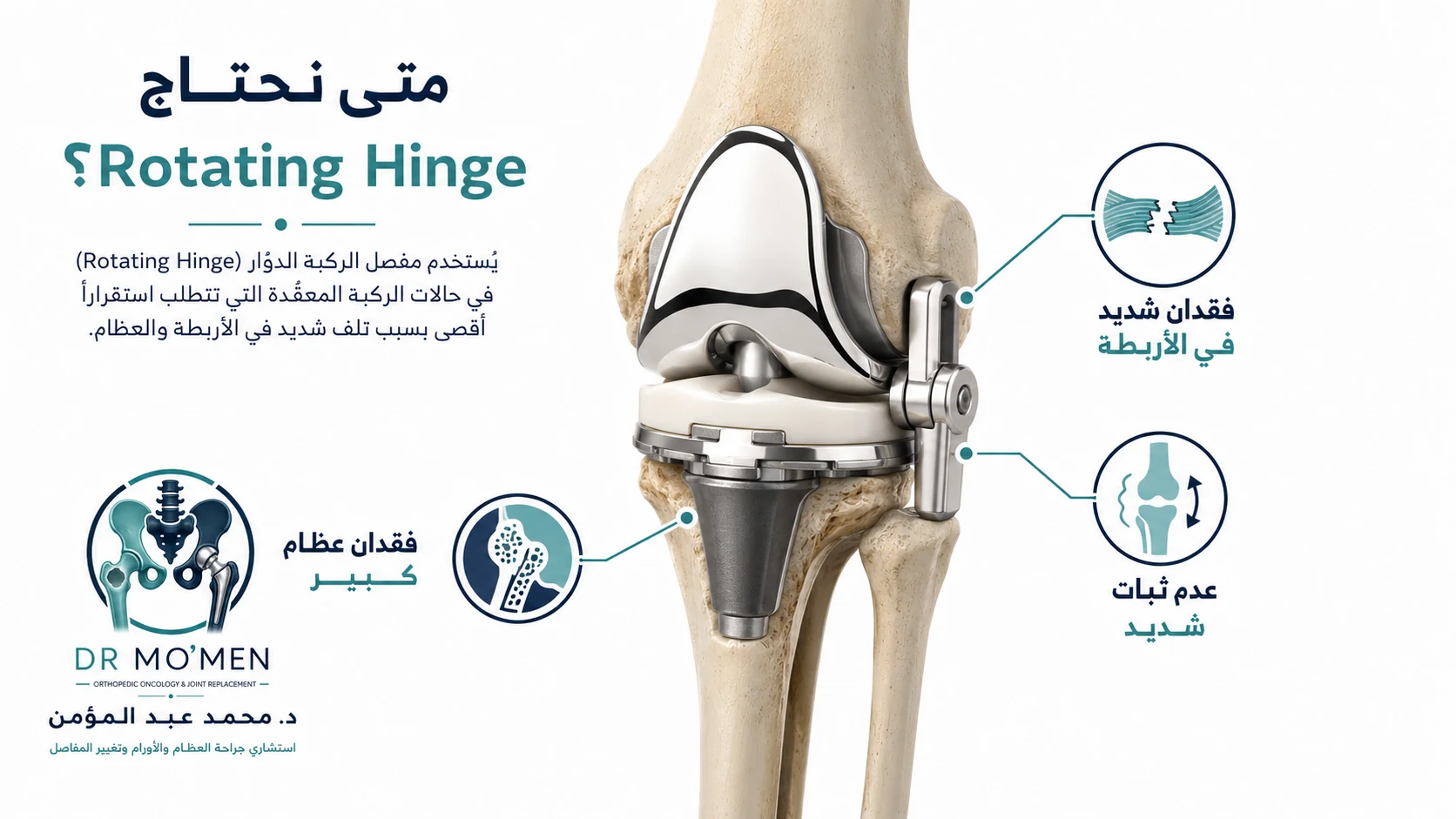 رسم طبي يوضح مفصل الركبة Rotating Hinge المستخدم في حالات عدم الثبات الشديد وفقدان وظيفة الأربطة.