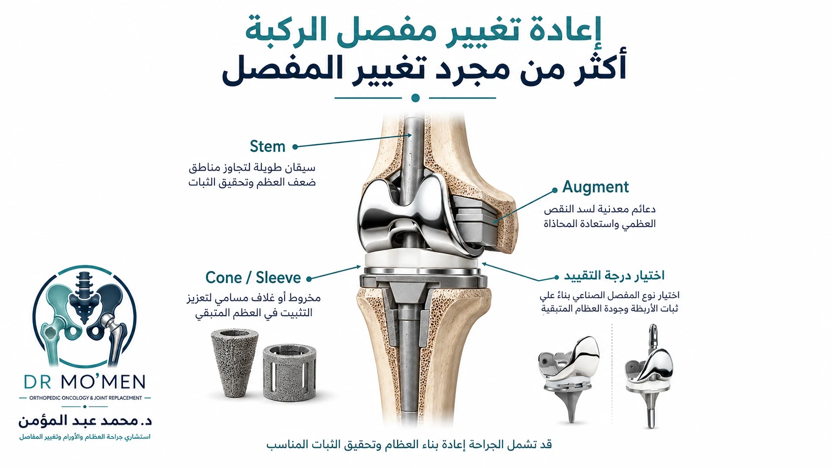 رسم طبي يوضح عناصر إعادة بناء الركبة المعقدة مثل stems وaugments وcones أو sleeves مع اختيار درجة التقييد.