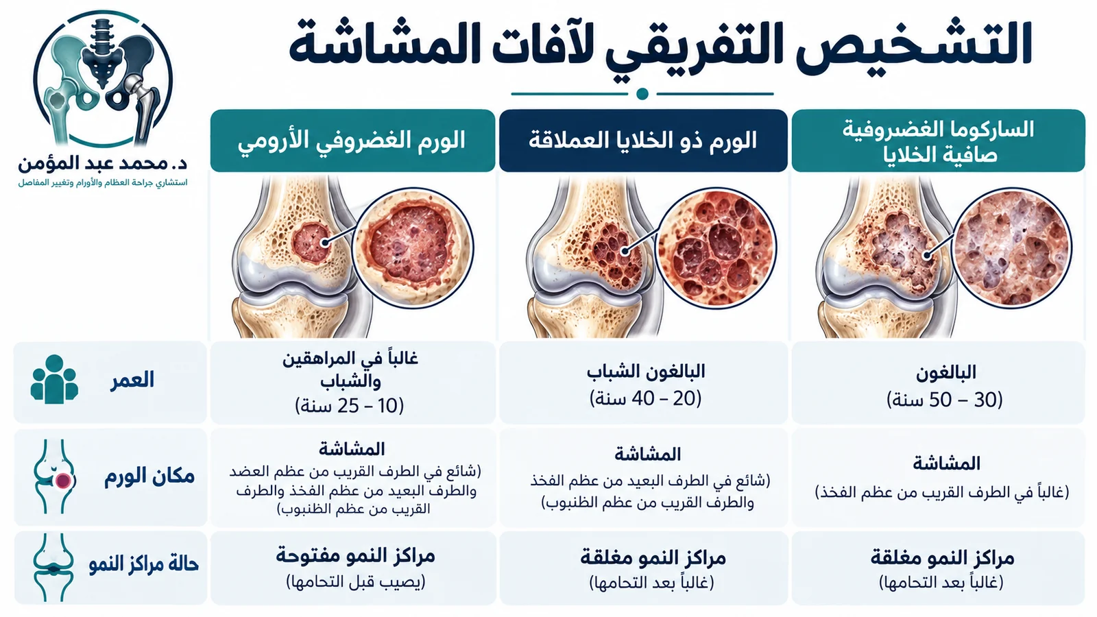 إنفوجرافيك عربي يقارن بين الورم الغضروفي الأرومي وورم الخلايا العملاقة والساركوما الغضروفية صافية الخلايا ضمن آفات المشاشة.
