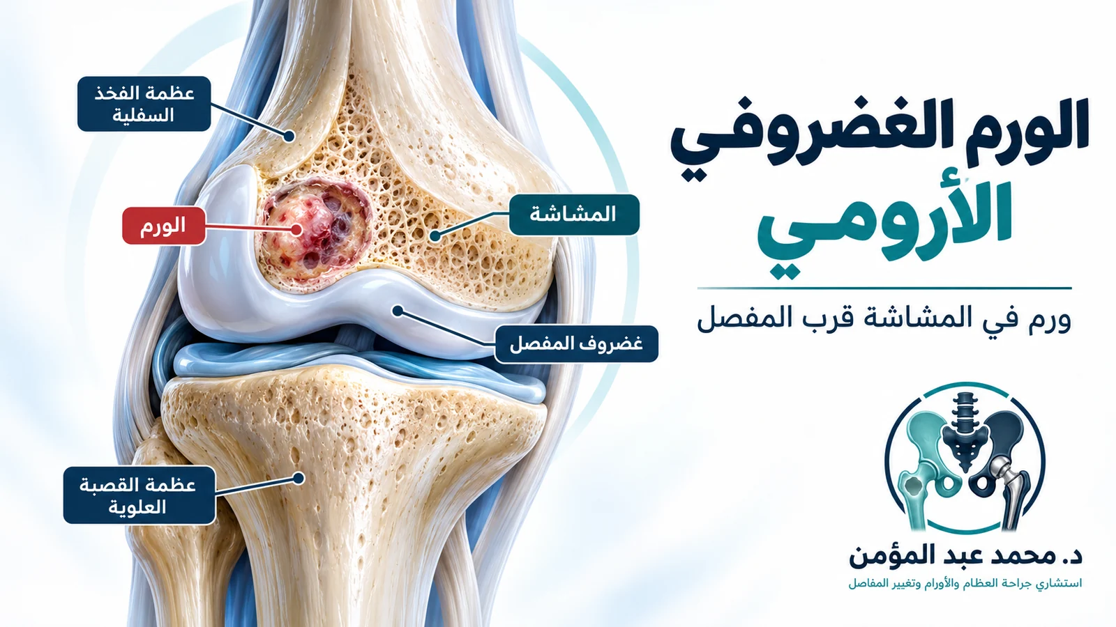 رسم طبي ثلاثي الأبعاد يوضح الورم الغضروفي الأرومي في مشاشة الطرف السفلي لعظمة الفخذ بالقرب من غضروف مفصل الركبة.