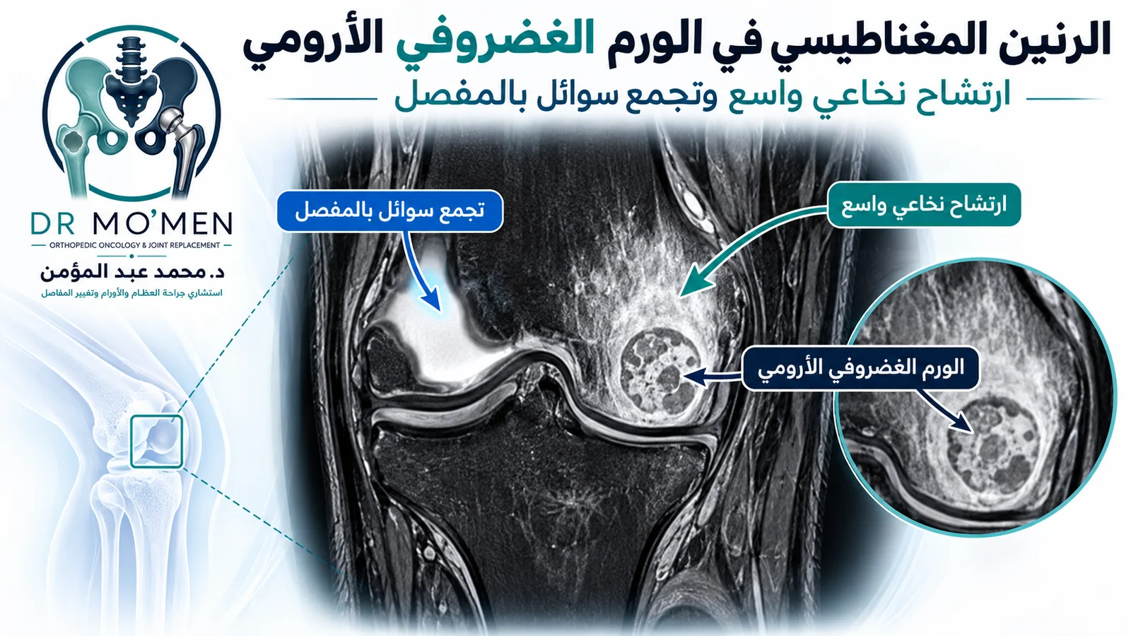 رسم تعليمي بأسلوب الرنين المغناطيسي يوضح ورمًا غضروفيًا أروميًا صغيرًا مع ارتشاح نخاعي واسع وارتشاح داخل المفصل.
