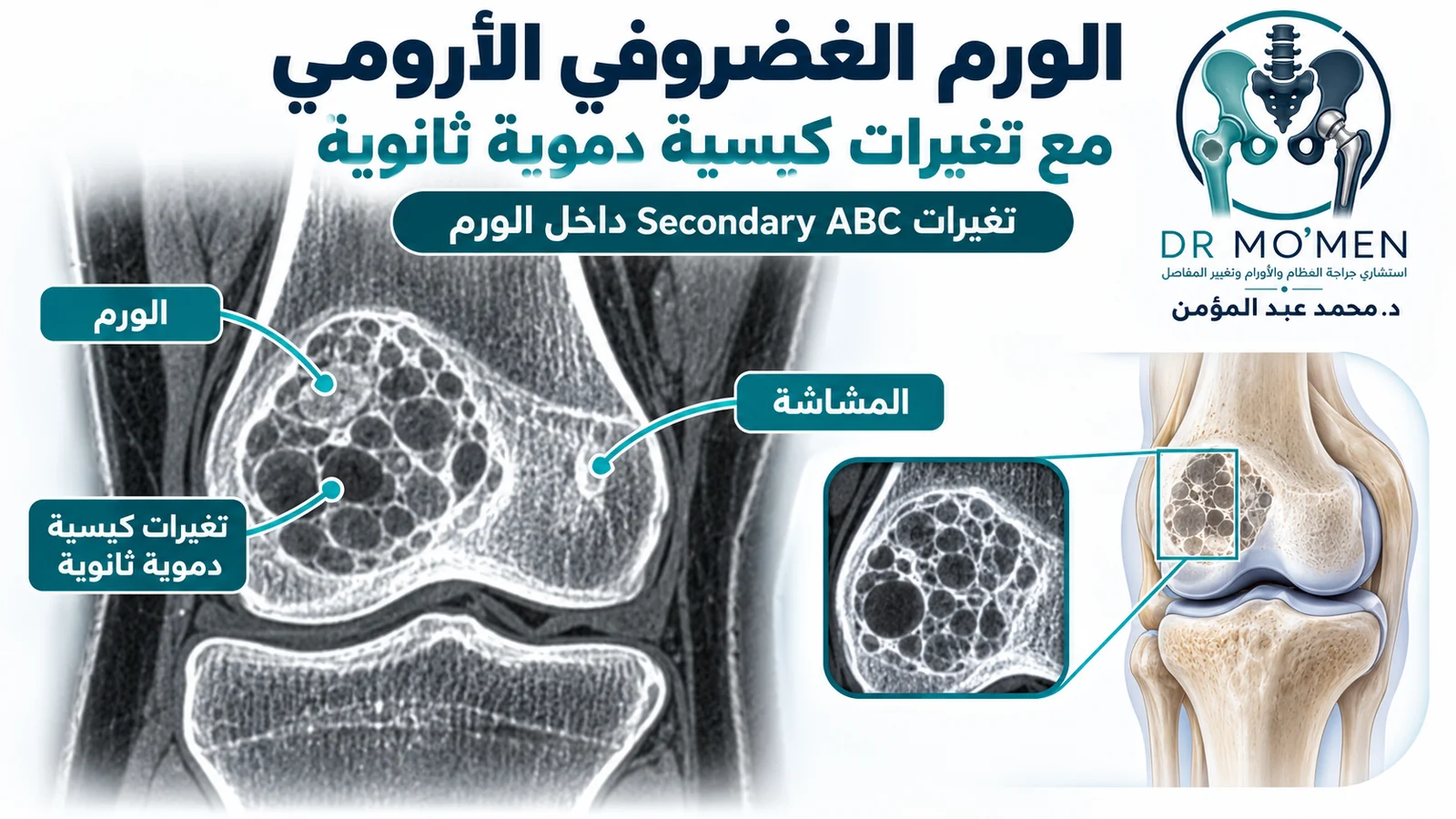 رسم تعليمي بأسلوب الأشعة يوضح الورم الغضروفي الأرومي مع تغيرات كيسية دموية ثانوية من نوع ABC.