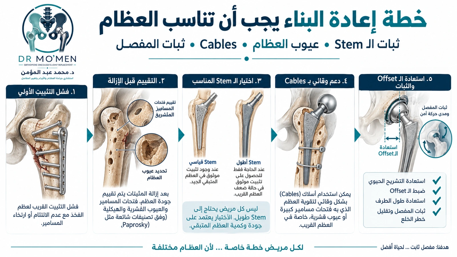 خطة إعادة البناء يجب أن تناسب العظام إنفوجرافيك طبي يوضح اختيار ساق المفصل ودعم العظام أثناء تغيير مفصل الفخذ بعد فشل تثبيت الكسر.