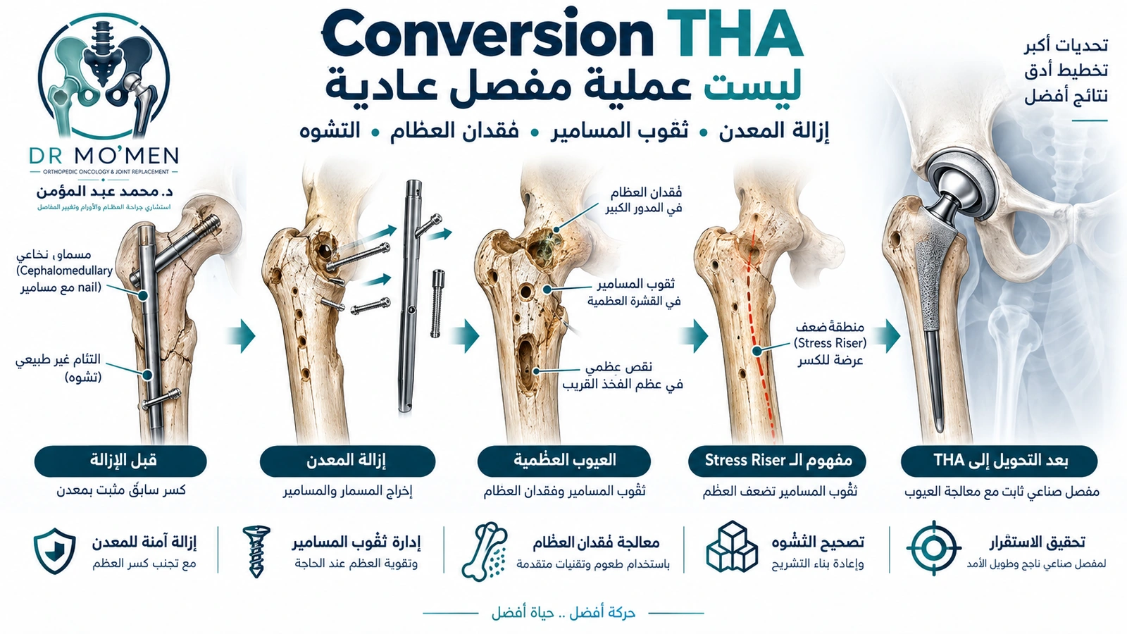 Conversion THA ليست عملية مفصل عادية رسم طبي يوضح إزالة المسامير والمعدن القديم وثقوب العظام أثناء التحضير لـConversion Total Hip Arthroplasty.