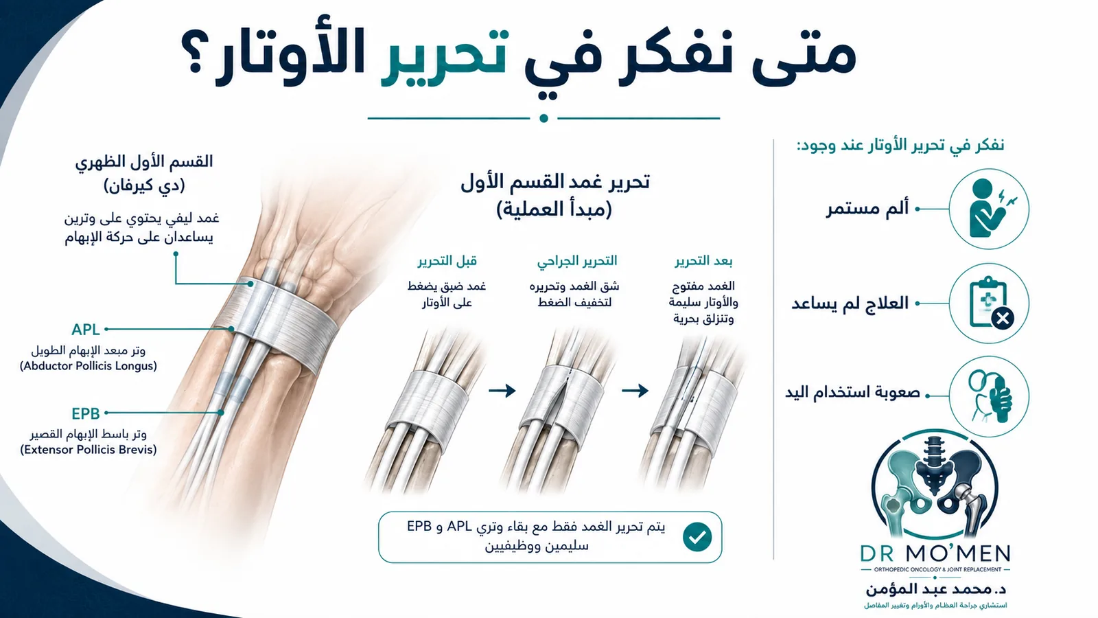 رسم طبي يوضح متى يمكن التفكير في جراحة تحرير أوتار دي كيرفان.