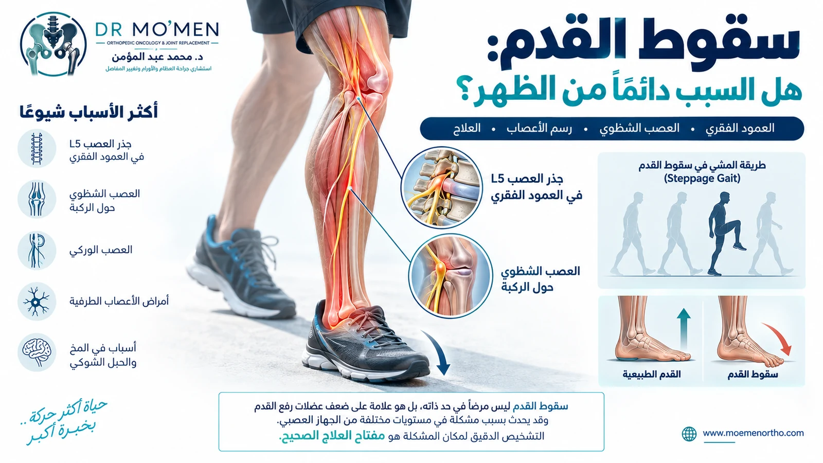 إنفوجرافيك طبي يوضح أن سقوط القدم قد ينتج من مستويات عصبية مختلفة من العمود الفقري إلى العصب الشظوي والعضلات المسؤولة عن رفع القدم.