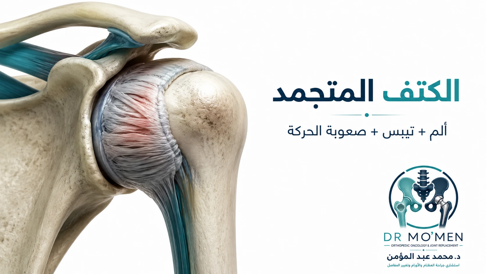 رسم طبي ثلاثي الأبعاد يوضح الكتف المتجمد وسماكة محفظة مفصل الكتف مع الألم والتيبس وصعوبة الحركة.