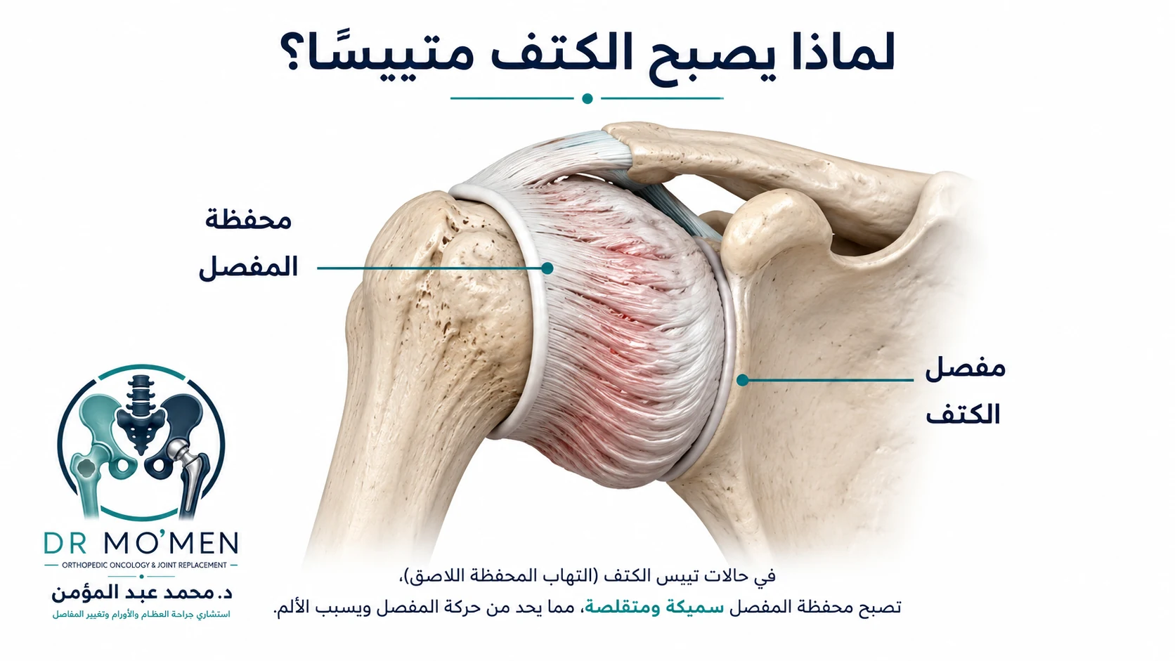 توضيح تشريحي لمفصل الكتف يبين سماكة وتقلص محفظة المفصل في الكتف المتجمد.