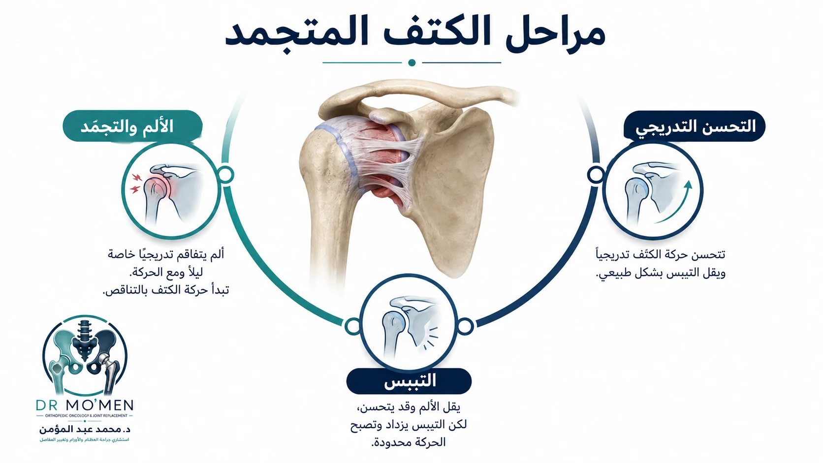 رسم تعليمي يوضح مراحل الكتف المتجمد من الألم والتجمد إلى التيبس ثم التحسن التدريجي.