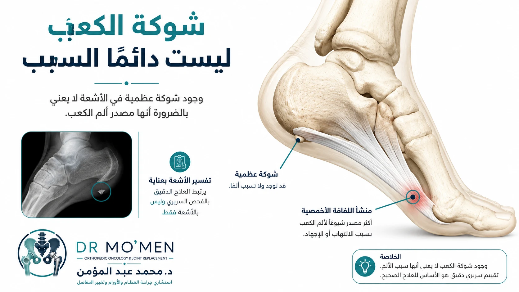 توضيح طبي يبين أن شوكة الكعب في الأشعة قد لا تكون مصدر الألم