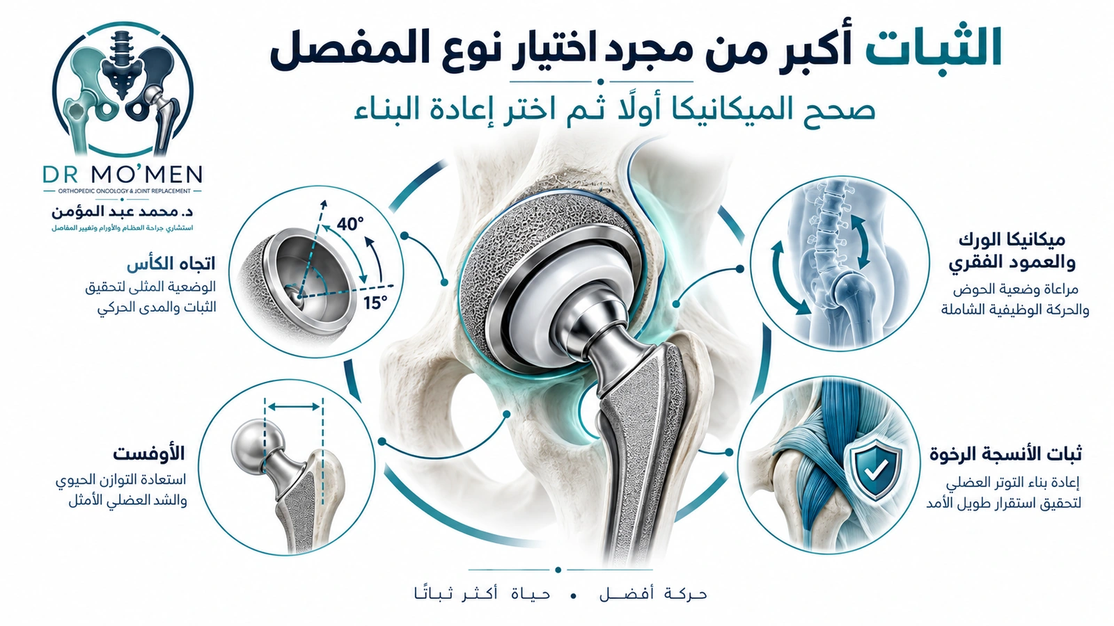 رسم طبي يوضح التخطيط الميكانيكي واستخدام Dual Mobility في حالات مختارة من عدم ثبات مفصل الفخذ الصناعي.
