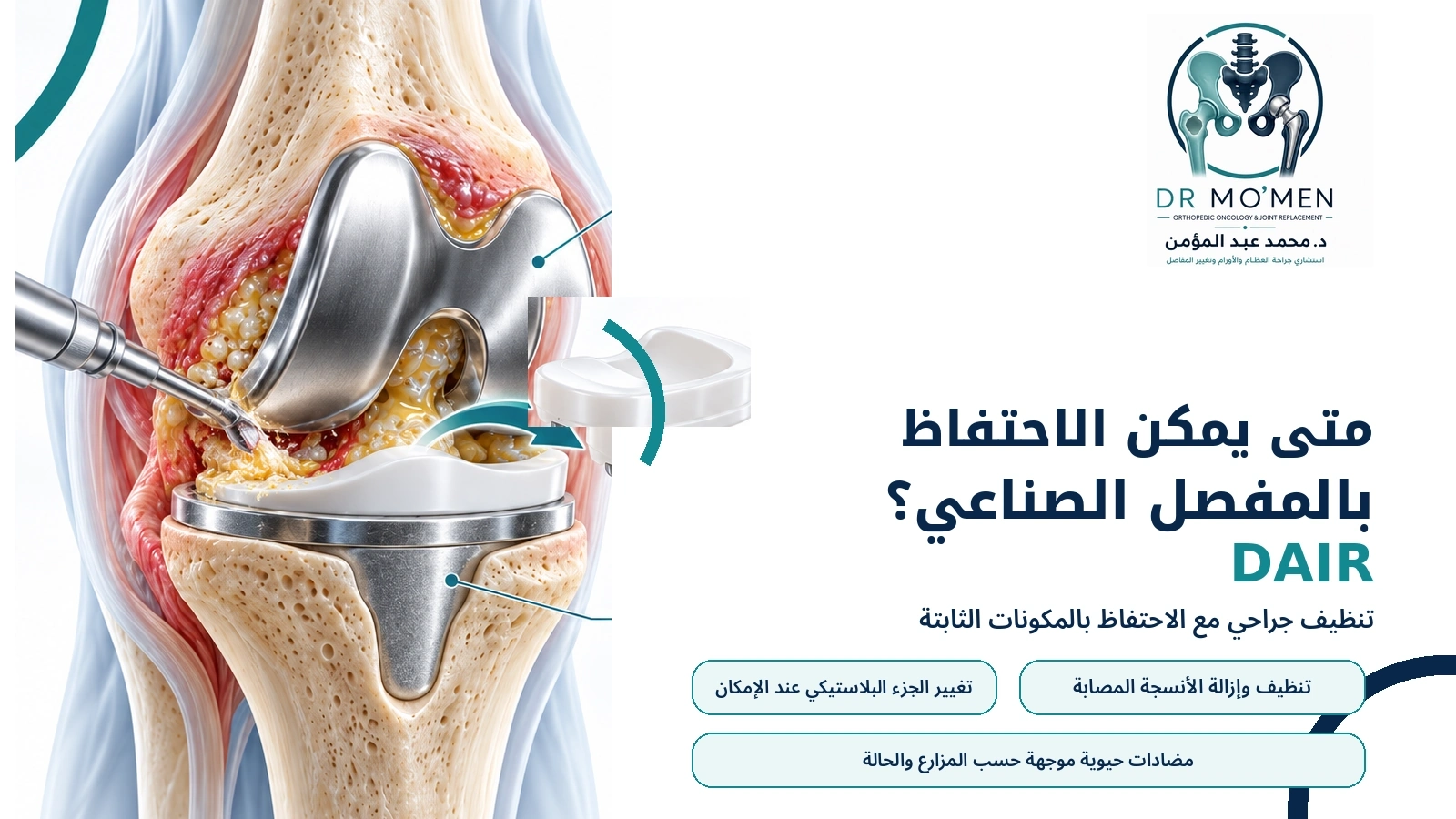 متى يمكن الاحتفاظ بالمفصل؟