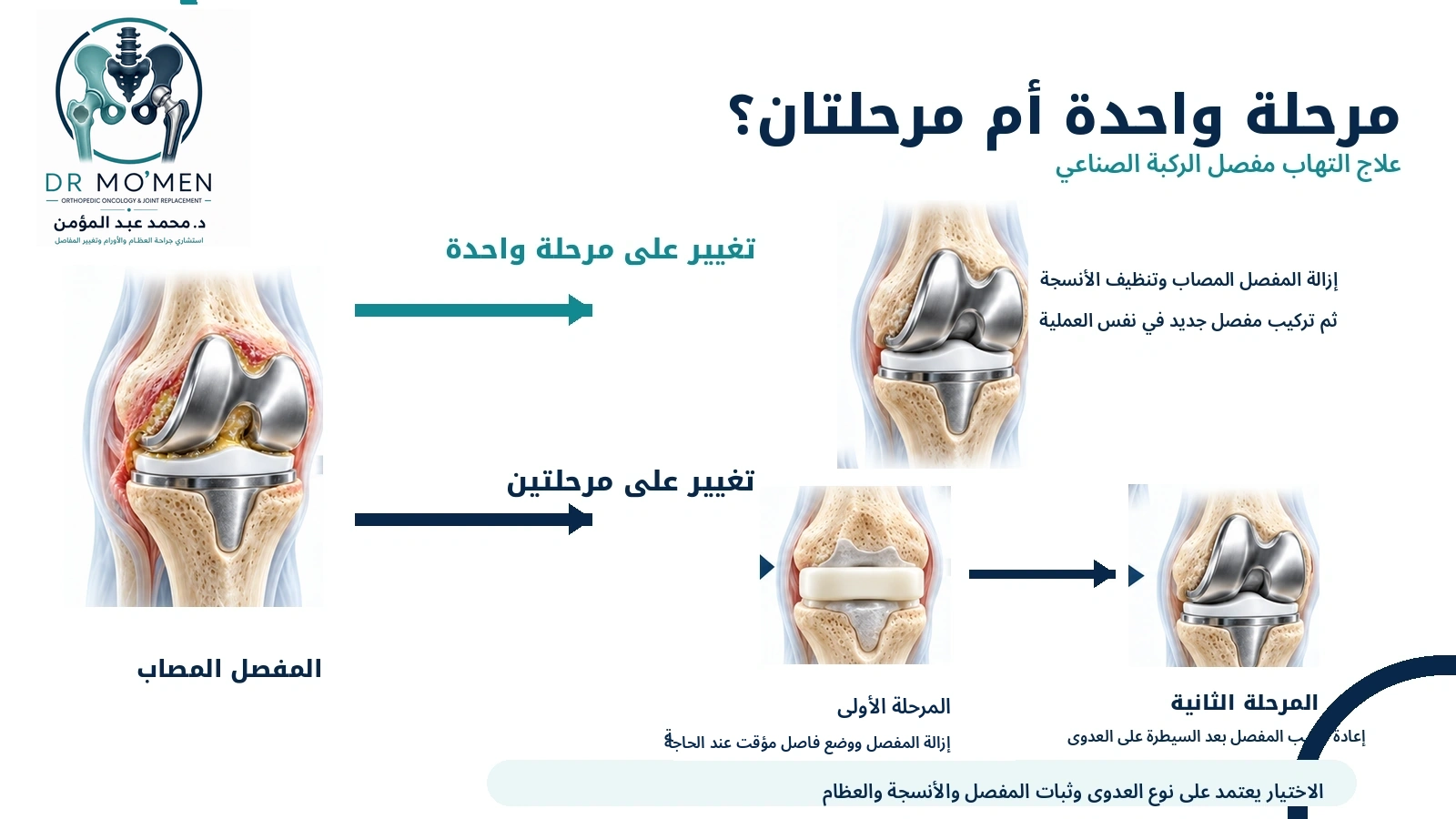 مرحلة واحدة أم مرحلتان؟