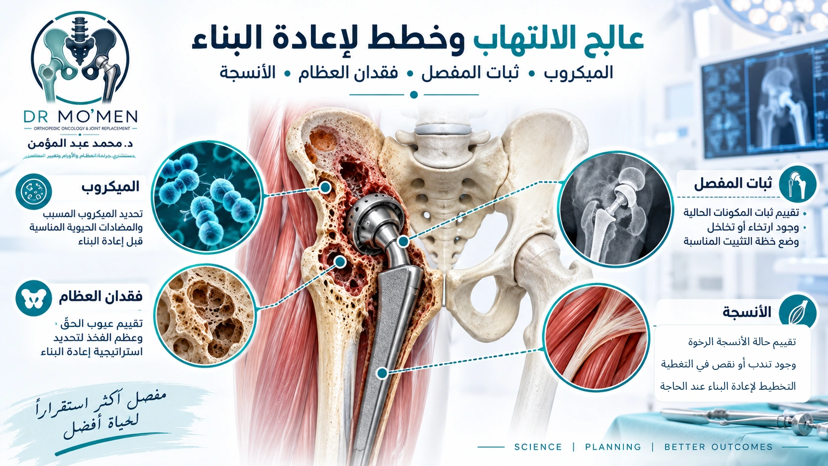 رسم طبي يوضح الميكروب وثبات المفصل وفقدان العظام والأنسجة ضمن التخطيط لجراحة مراجعة مفصل فخذ مصاب بالالتهاب.