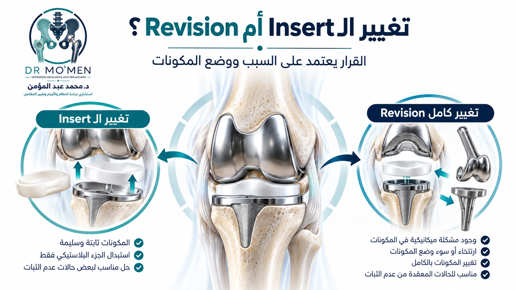 تغيير الـInsert أم Revision؟ رسم طبي يوضح أن تغيير الجزء البلاستيكي يناسب حالات محددة بينما تحتاج بعض المشاكل الميكانيكية إلى Revision.