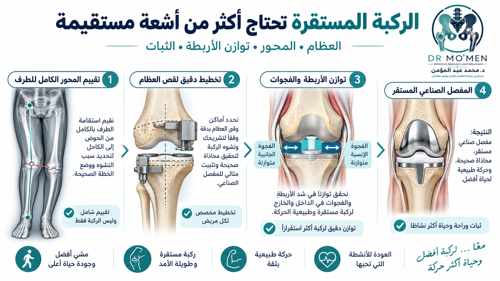 الركبة المستقرة تحتاج أكثر من أشعة مستقيمة إنفوجرافيك يوضح التخطيط لمحور الطرف وتوازن الأربطة أثناء تغيير مفصل الركبة في حالات التقوس الشديد.