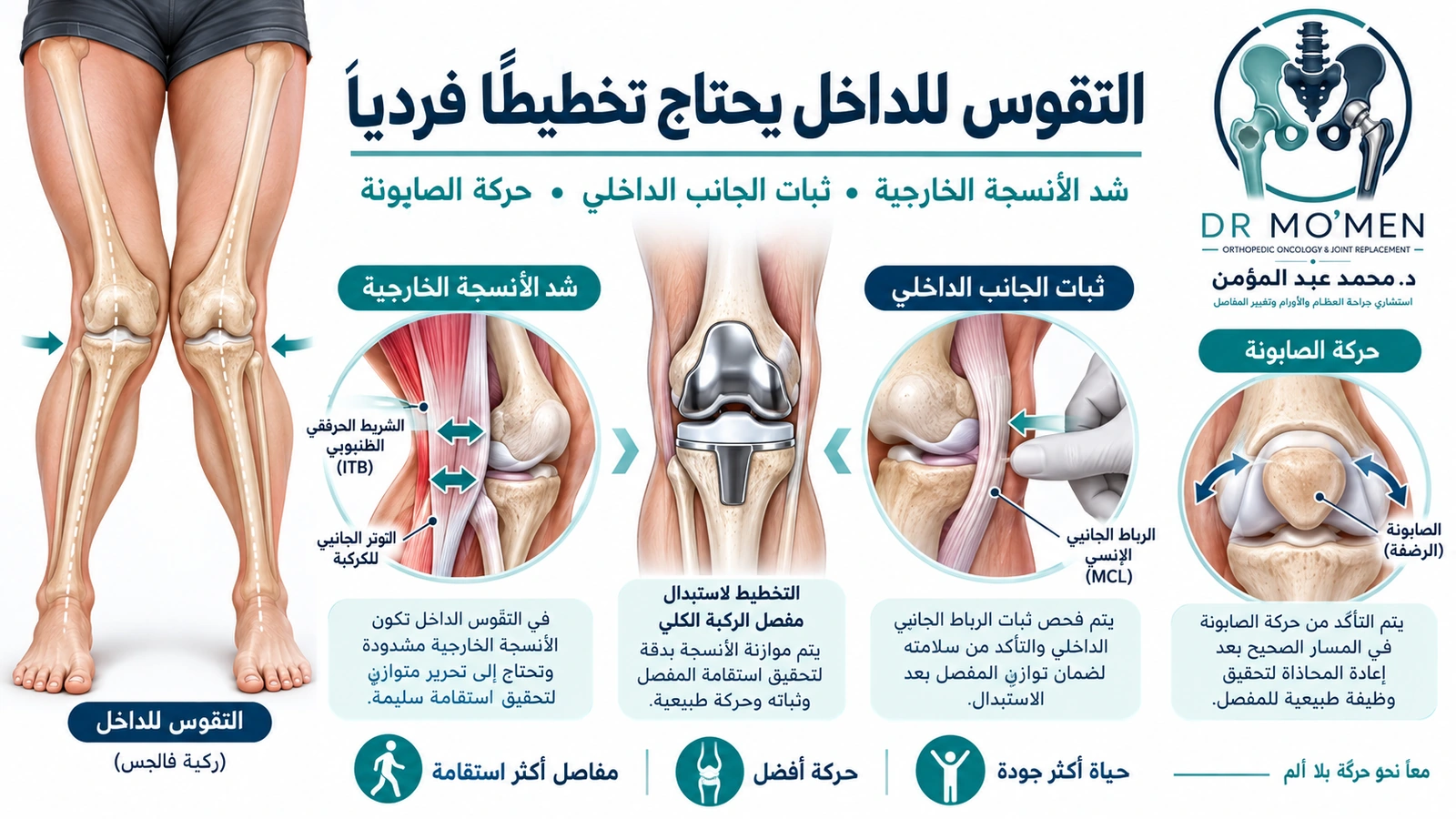 التقوس للداخل يحتاج تخطيطًا فرديًا إنفوجرافيك طبي يوضح مشكلات الأربطة وحركة الصابونة في تغيير مفصل الركبة مع التقوس الشديد للداخل.