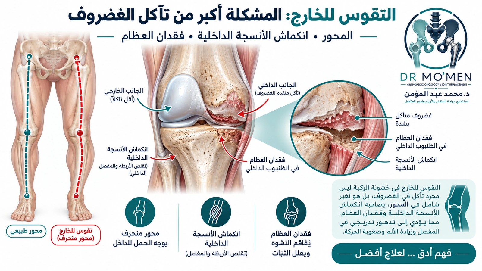 التقوس للخارج: المشكلة أكبر من تآكل الغضروف رسم طبي يوضح خشونة الركبة مع تقوس شديد للخارج وتآكل الجزء الداخلي وفقدان العظام.