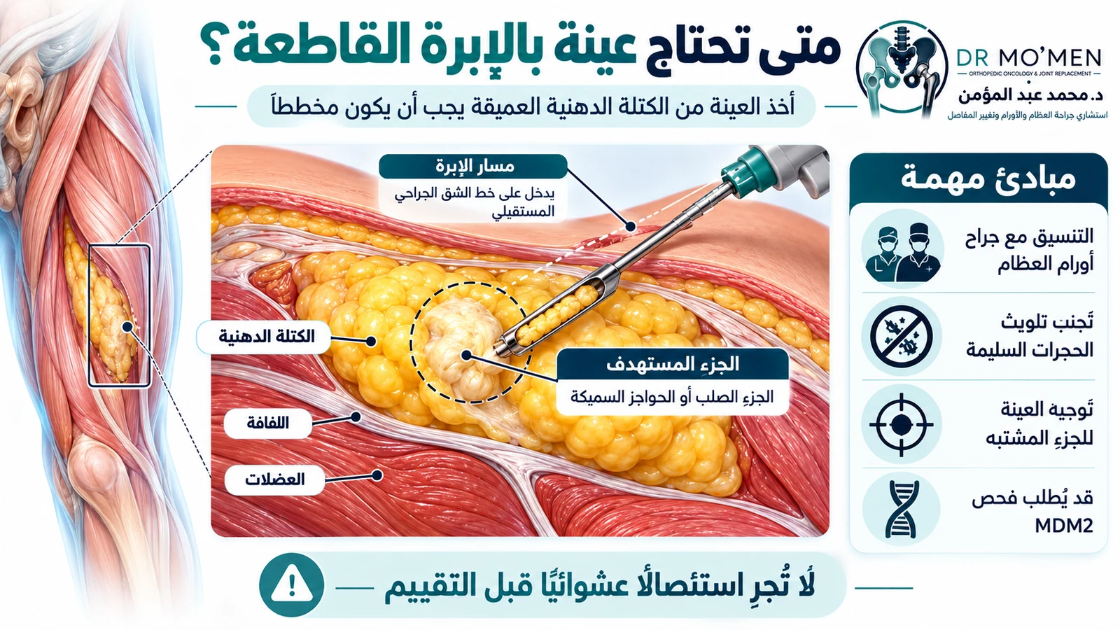 مخطط تعليمي لمسار عينة بالإبرة القاطعة من ورم دهني عميق بعد تقييم متخصص.