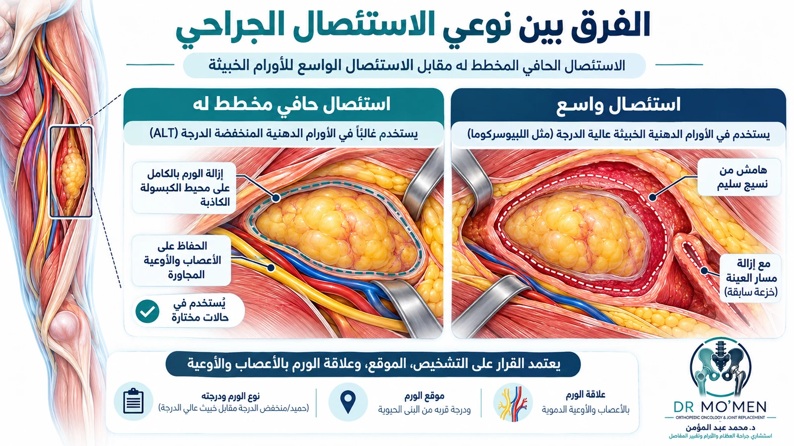 مقارنة تعليمية بين الاستئصال الحافي والاستئصال الواسع وفق نوع الورم الدهني.