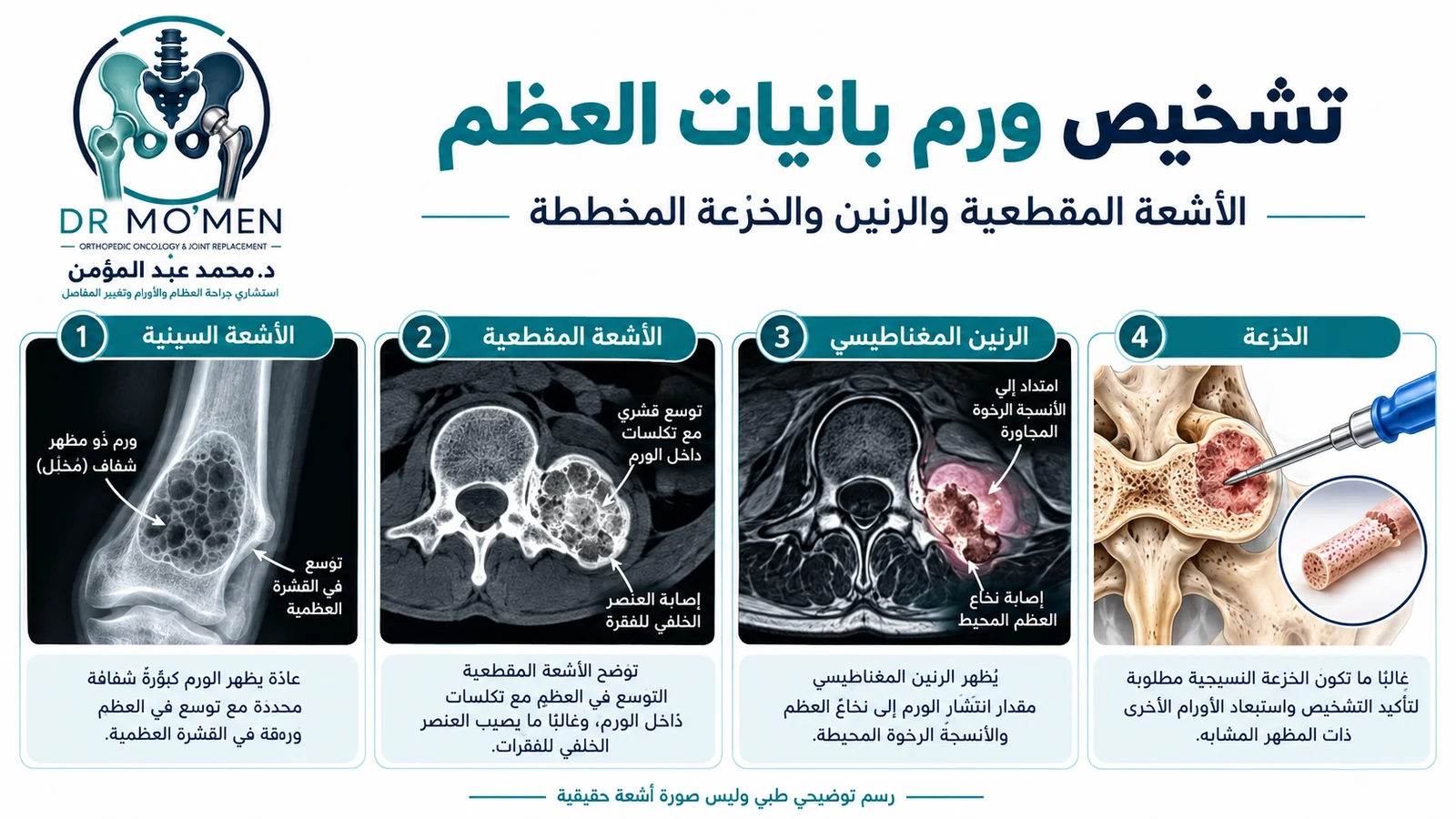 إنفوجرافيك طبي توضيحي يشرح دور الأشعة السينية والمقطعية والرنين والخزعة المخططة في تشخيص ورم بانيات العظم.