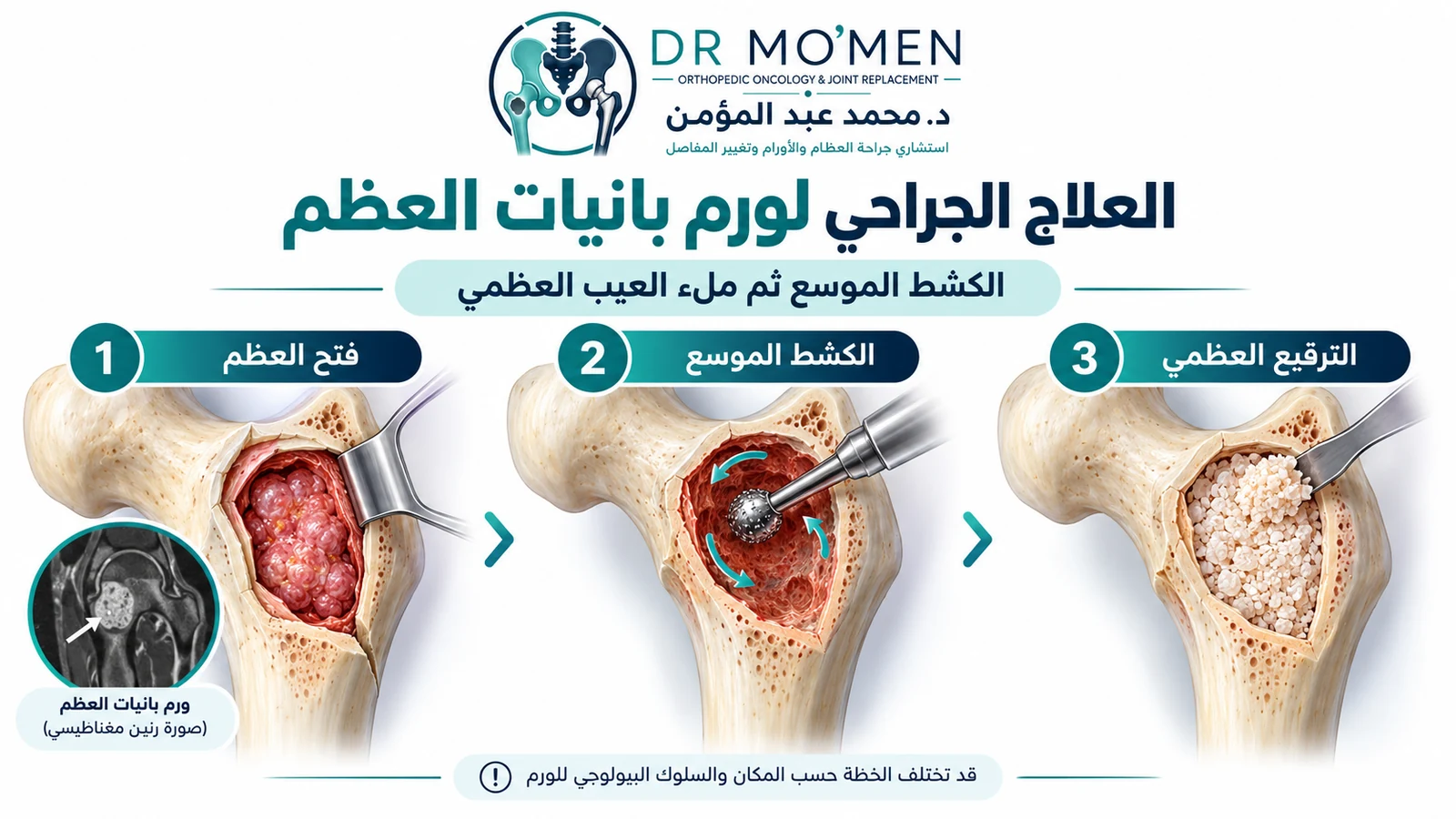 رسم جراحي توضيحي يشرح فتح العظم والكحت الموسع ثم ملء العيب العظمي في حالات مختارة من ورم بانيات العظم.