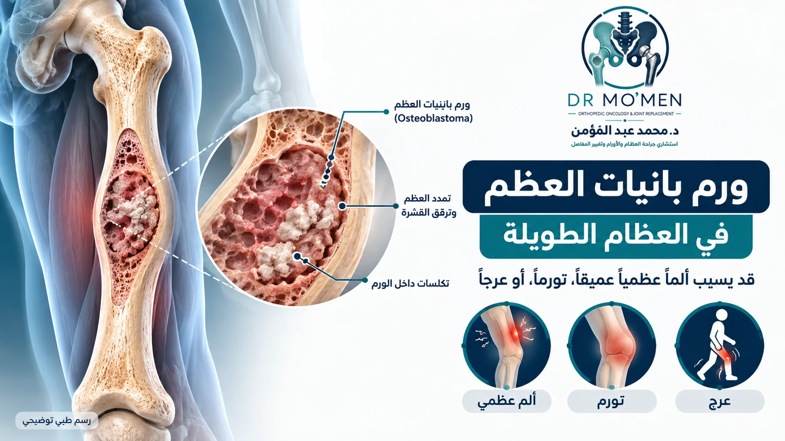 رسم طبي توضيحي لورم بانيات العظم في عظمة طويلة مع أعراض محتملة تشمل الألم العظمي والتورم والعرج.