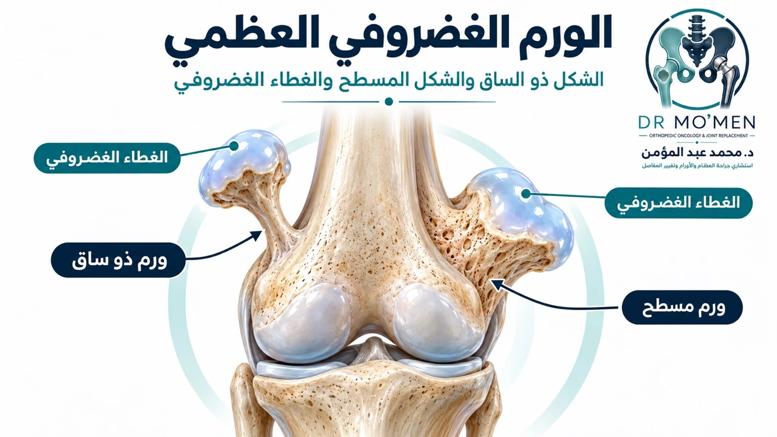 الورم الغضروفي العظمي (Osteochondroma): الأعراض والغطاء الغضروفي ومتى نحتاج إلى الجراحة