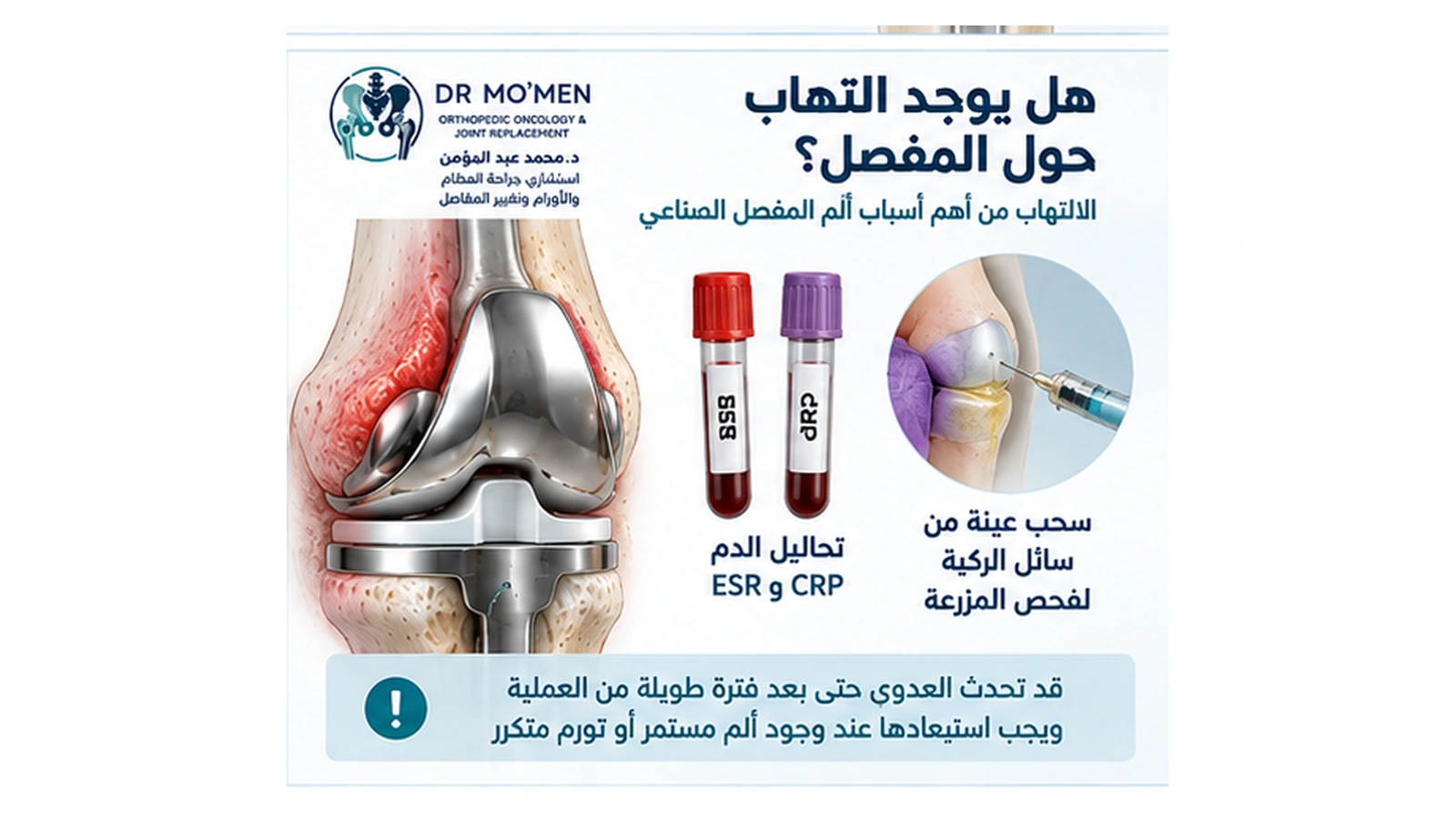 هل يوجد التهاب حول المفصل؟ رسم طبي يوضح تقييم التهاب مفصل الركبة الصناعي باستخدام ESR وCRP وسحب السائل المفصلي.