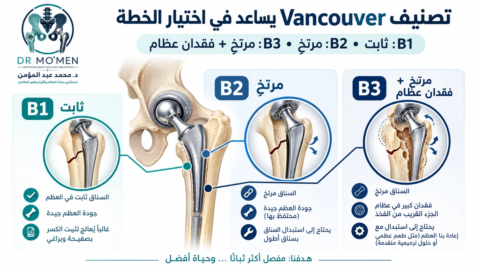 إنفوجرافيك طبي يشرح تصنيف Vancouver B1 وB2 وB3 للكسور حول مفصل الفخذ الصناعي.