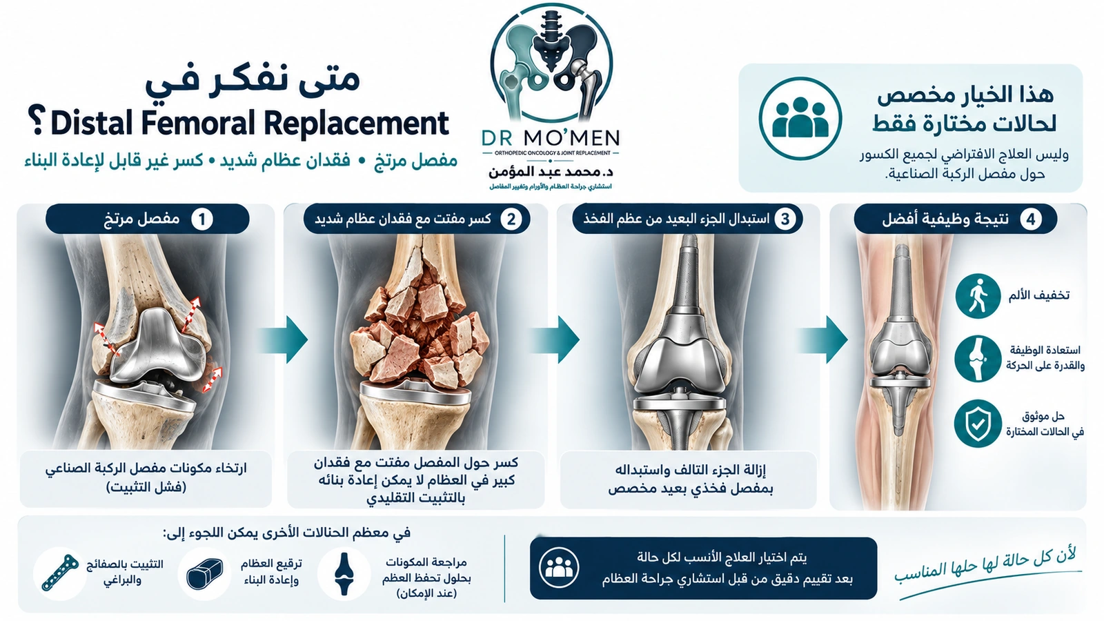 إنفوجرافيك طبي يوضح استخدام استبدال الجزء البعيد من عظمة الفخذ في حالات مختارة من الكسور المعقدة حول مفصل الركبة مع فقدان شديد للعظام.