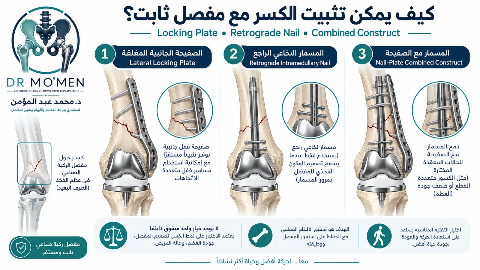 إنفوجرافيك طبي يوضح استخدام الشريحة أو المسمار الراجع أو التثبيت المركب لعلاج كسر فوق مفصل ركبة صناعي ثابت.