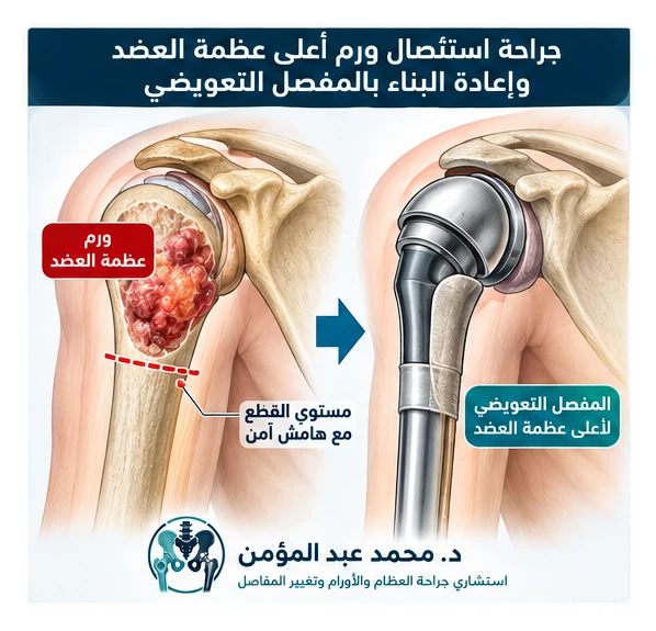 رسم تعليمي يوضح استئصال ورم أعلى عظمة العضد وإعادة البناء بالمفصل التعويضي للأورام.