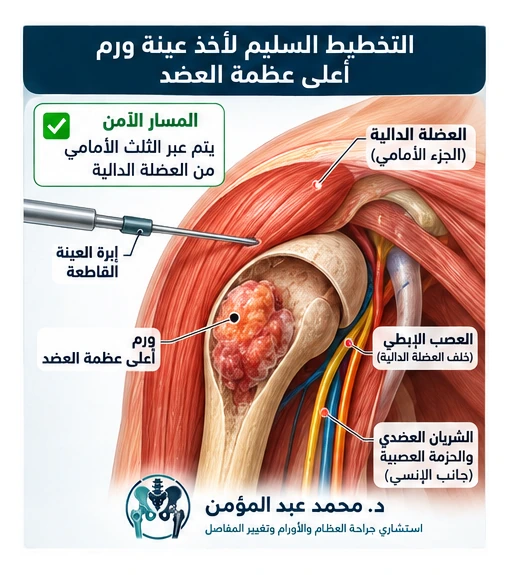 رسم تشريحي يوضح التخطيط لمسار عينة ورم أعلى عظمة العضد مع حماية الأعصاب والأوعية والعضلة الدالية.