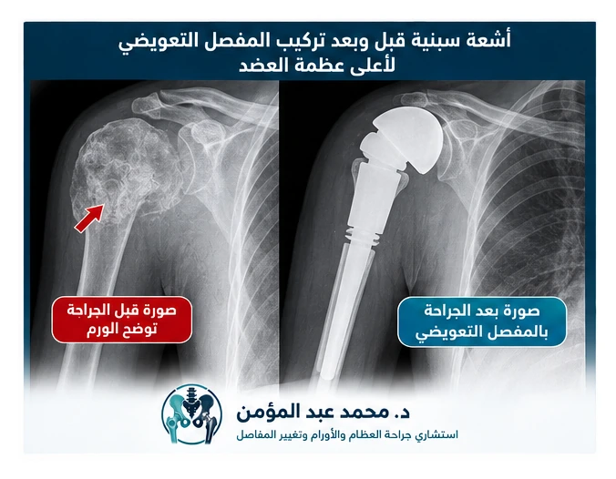 صورة تعليمية تحاكي الأشعة قبل وبعد إعادة بناء أعلى عظمة العضد بالمفصل التعويضي، وليست أشعة لمريض حقيقي.