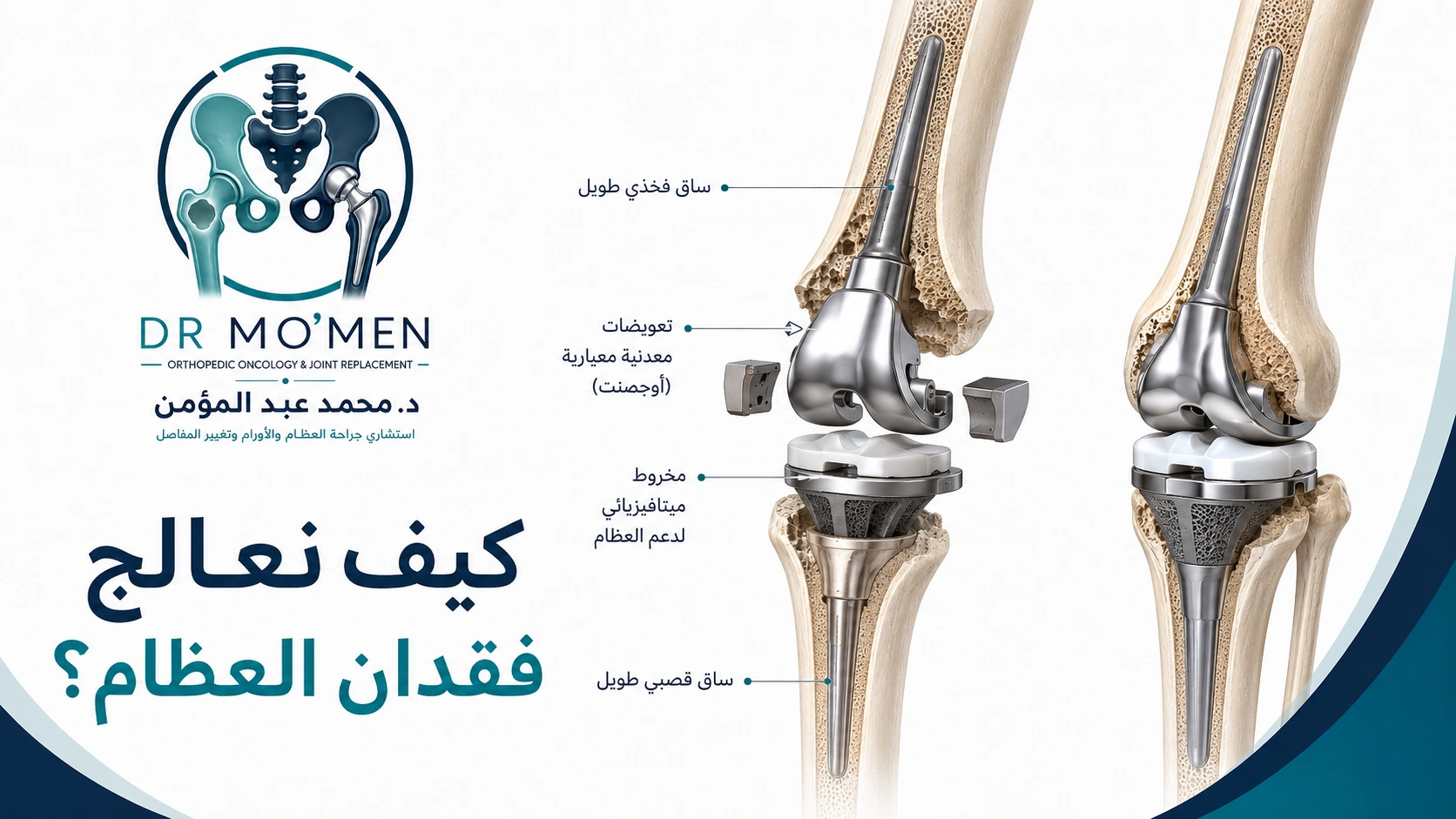 إعادة بناء فقدان العظام في Revision Knee رسم طبي ثلاثي الأبعاد يوضح استخدام السيقان والقطع التعويضية والمخاريط المعدنية في حالات فقدان العظام أثناء Revision Knee.