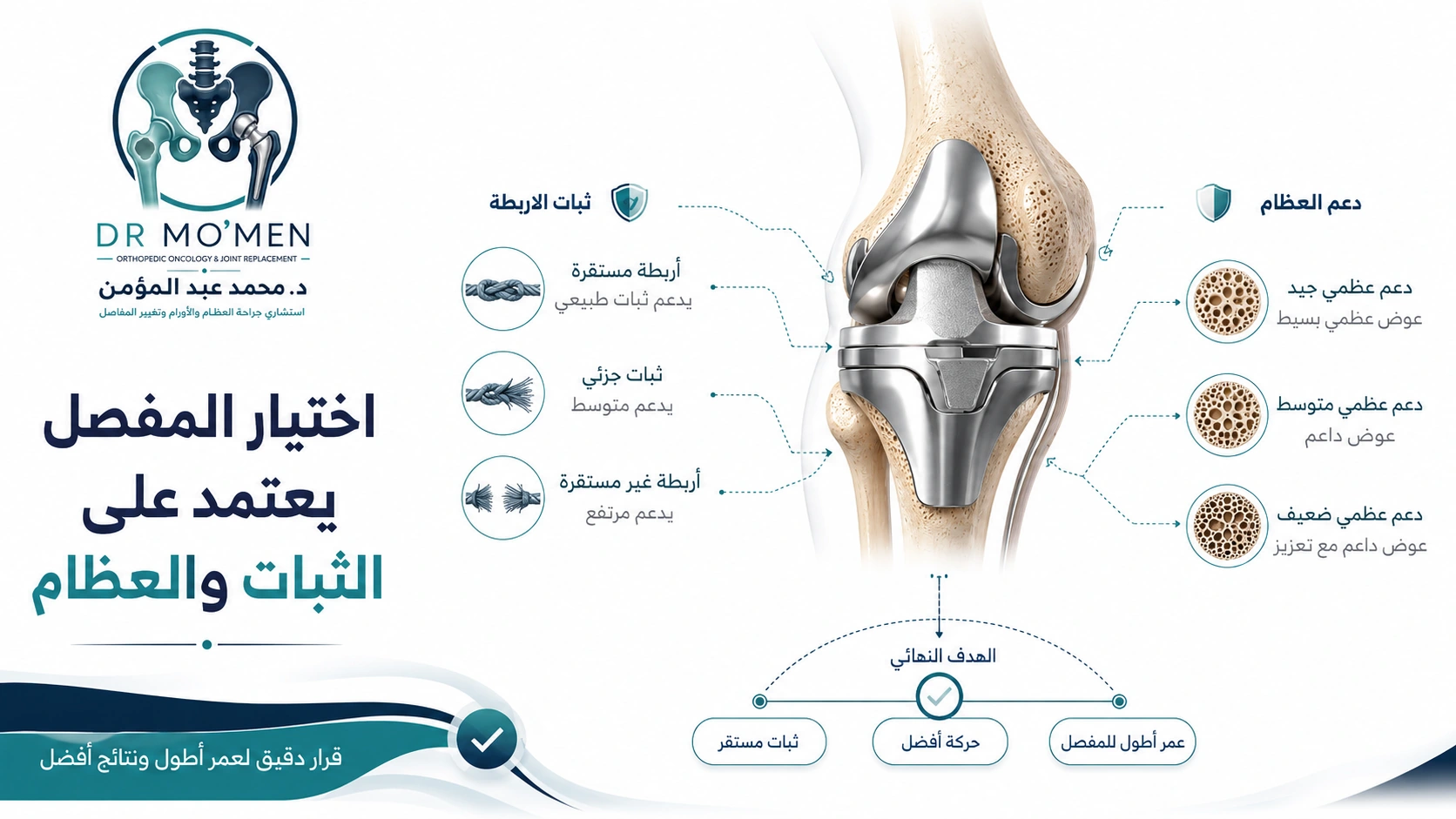 اختيار درجة الثبات يعتمد على الأربطة والعظام رسم تعليمي يوضح أن اختيار درجة ثبات مفصل الركبة في جراحات Revision يعتمد على حالة الأربطة والعظام.