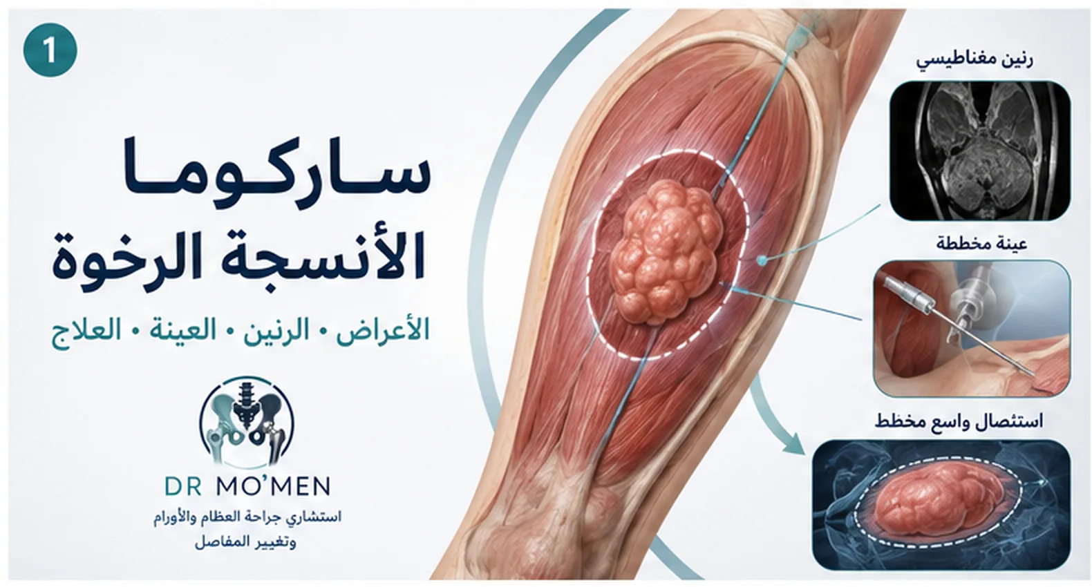 رسم طبي لساركوما عميقة في عضلات الفخذ مع الرنين وتخطيط العينة والجراحة