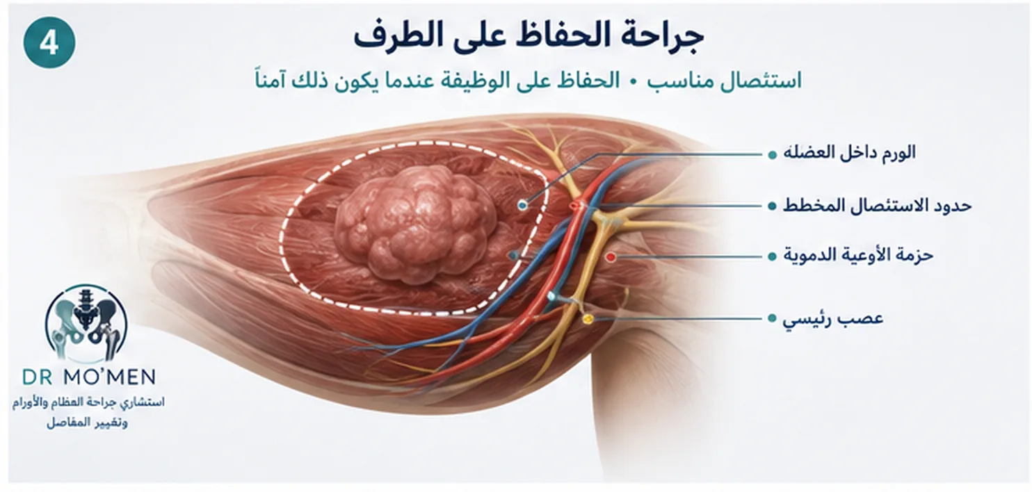 رسم ثلاثي الأبعاد يوضح تخطيط الاستئصال الواسع لساركوما الفخذ مع الحفاظ على الأعصاب والأوعية عند إمكانية ذلك بأمان