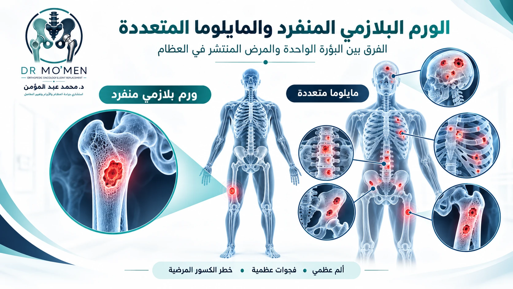 رسم طبي يوضح الورم البلازمي المنفرد في عظمة واحدة مقابل المثال الشائع لإصابة عظام متعددة في المايلوما، دون اعتبار العدد معيارًا كافيًا للتشخيص.