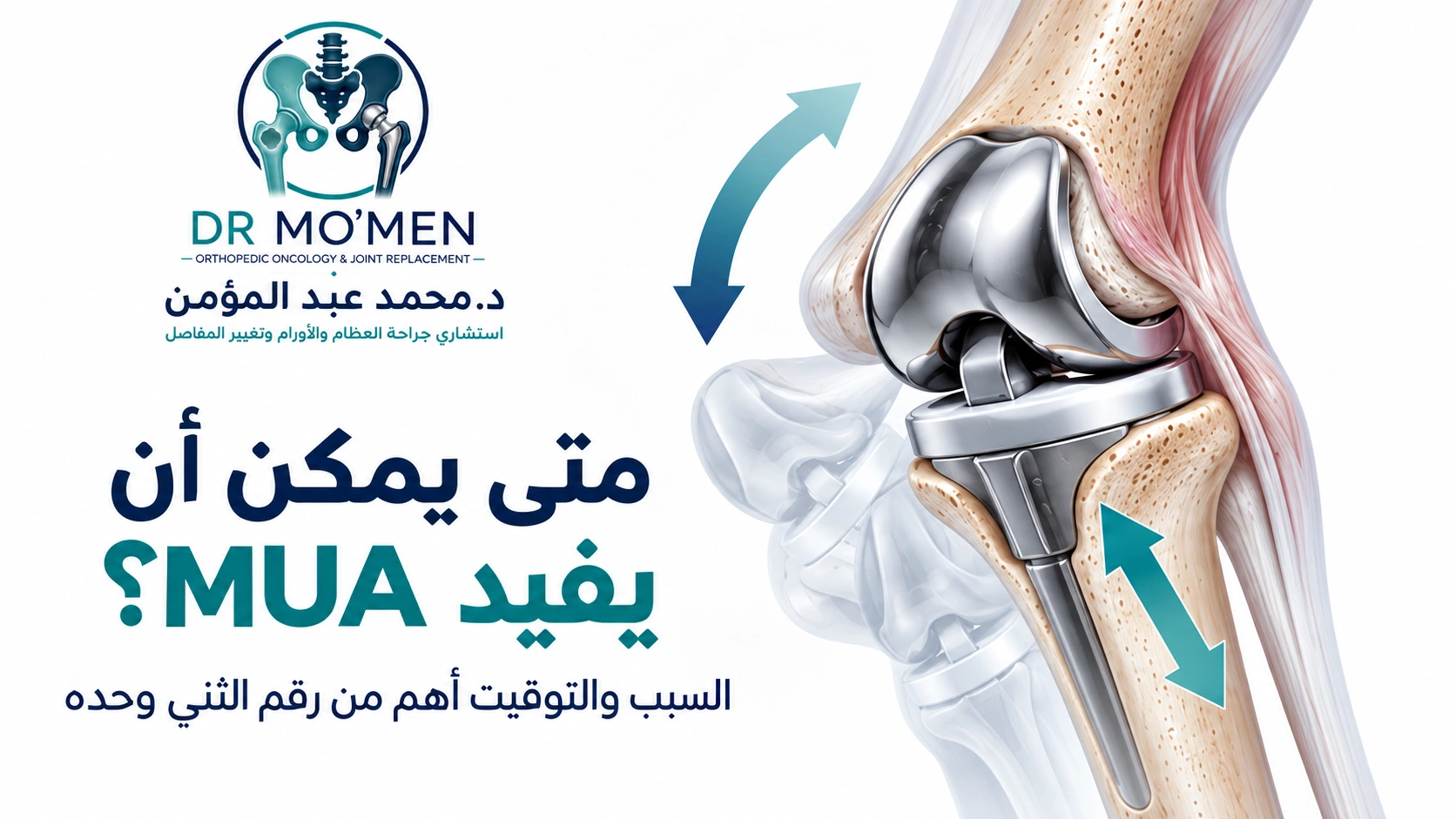 متى يمكن أن يفيد MUA؟ رسم طبي تعليمي يوضح مفهوم تحريك الركبة تحت التخدير لعلاج التيبس بعد تغيير المفصل.
