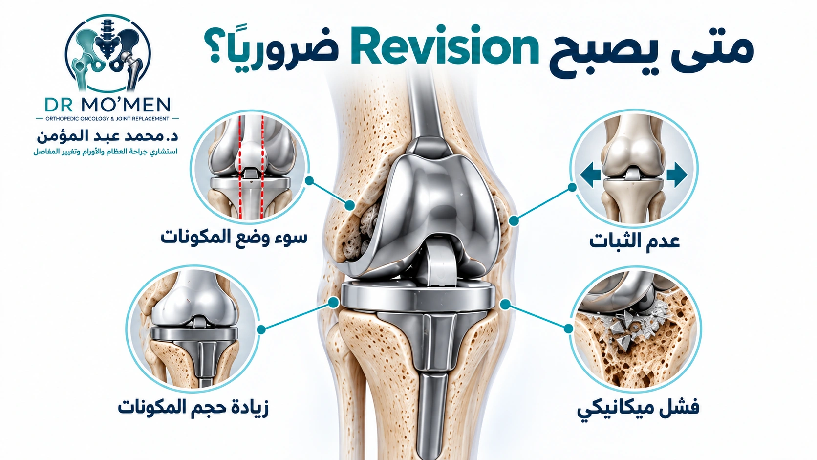 متى يصبح Revision ضروريًا؟ رسم طبي يوضح أن إعادة تغيير مفصل الركبة قد تكون ضرورية عند وجود مشكلة ميكانيكية.