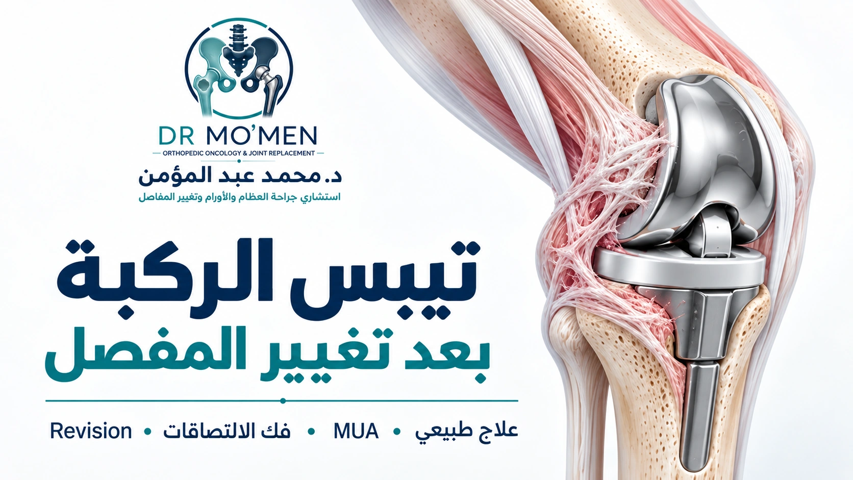 تيبس الركبة بعد تغيير المفصل رسم طبي يوضح تيبس الركبة بعد تغيير المفصل وخيارات العلاج المختلفة.