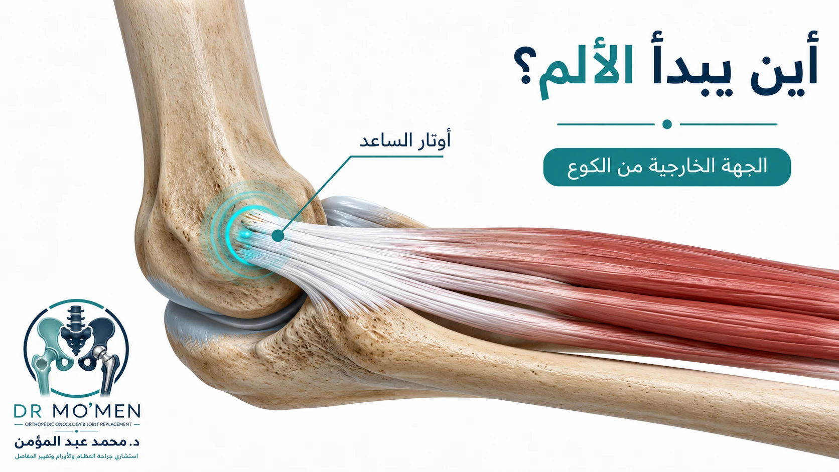 تشريح أوتار عضلات الساعد ومكان اتصالها بالجهة الخارجية من الكوع في مرفق التنس.