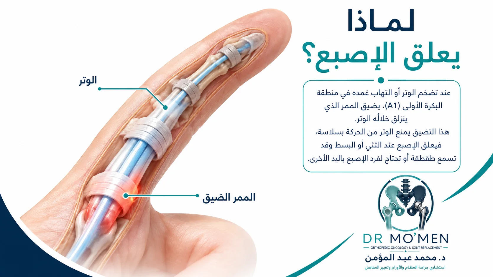 تشريح مبسط يوضح وتر الإصبع والمنطقة الضيقة التي تمنع انزلاقه بسهولة في الإصبع الزنادي.
